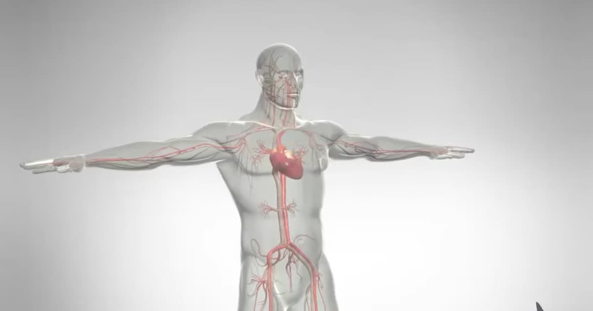 Heart Attack - Myocardial Infarction - 3D Animation